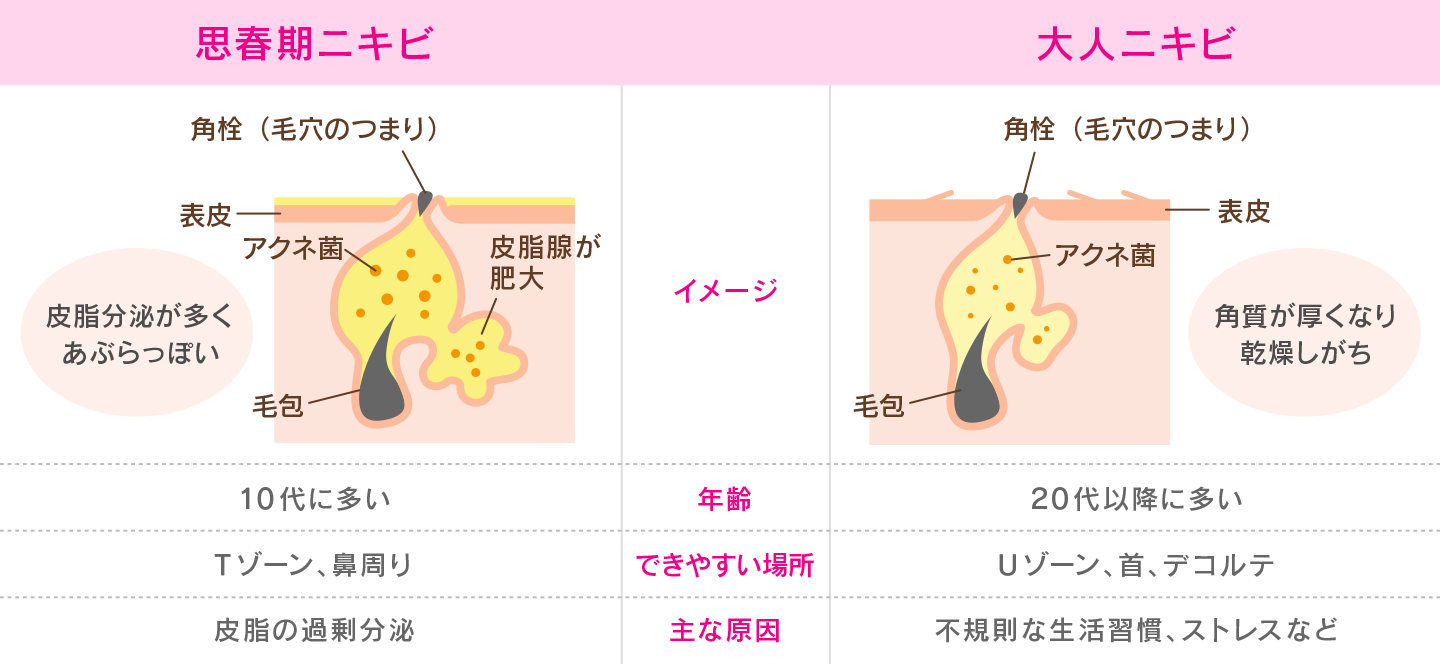 思春期ニキビと大人ニキビの違い