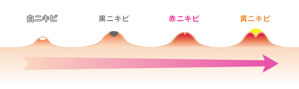 白ニキビから黄ニキビへの悪化イメージ