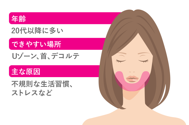 あごニキビの原因